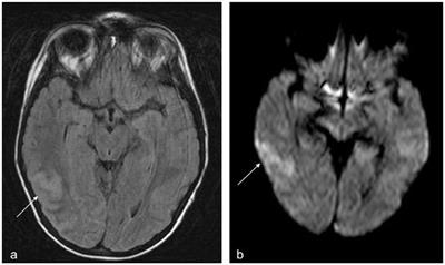 Central Venous Sinus Thrombosis in a Boy With Acute Severe Ulcerative Colitis